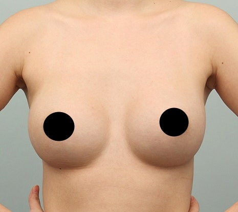 천안가슴수술? 실패로 이어지는 분들의 특징 2가지 사진 7