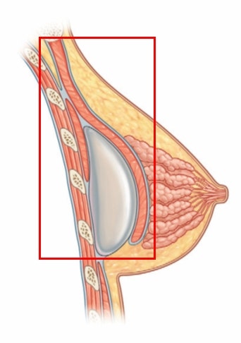 천안가슴수술? 실패로 이어지는 분들의 특징 2가지 사진 5