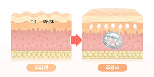 강남엘라비에리투오? 원리부터 효과 부작용까지 사진 4