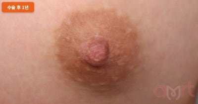 함몰유두수술비용? 가격만 보면 2배 비싸질 수 있습니다 사진 5
