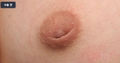 함몰유두수술비용? 가격만 보면 2배 비싸질 수 있습니다 사진 6