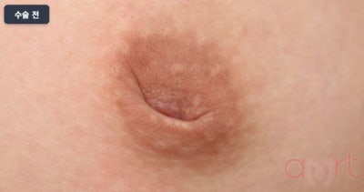 함몰유두수술비용? 가격만 보면 2배 비싸질 수 있습니다 사진 4