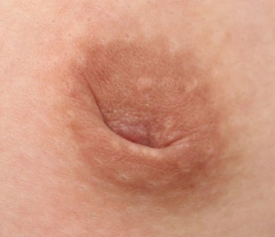 함몰유두수술가격 50만 원? 비용 보다 먼저 확인해야 할 이것 사진 3