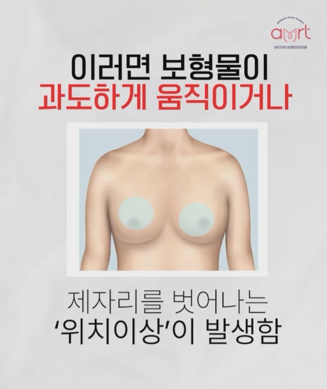 가슴재수술? 10명 중 8명은 '이것' 몰라 두 번째도 실패합니다 - 서초동성형외과 사진 5
