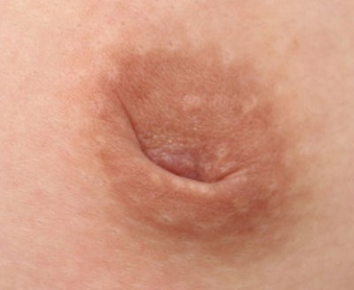 함몰유두 원인과 문제점, 수술 방법까지 총정리 사진 4