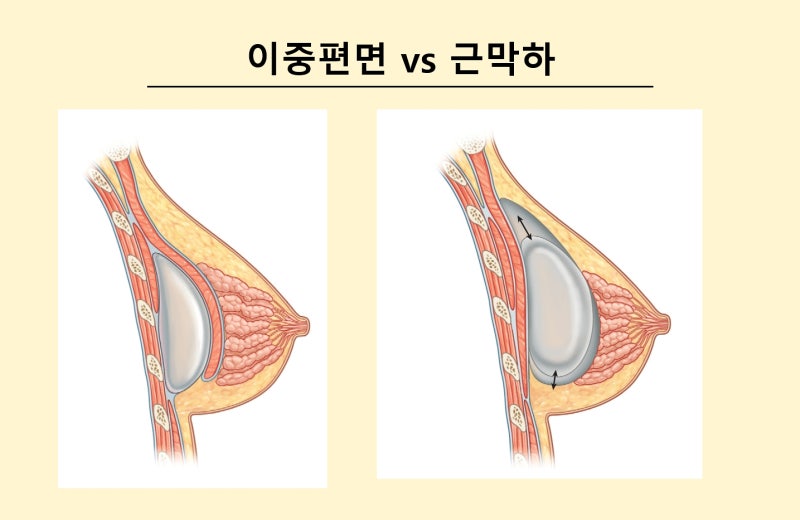 가슴확대수술? 10명 중 7명이 자주 하는 착각 2가지 사진 4