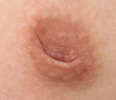 함몰유두수술병원, 콤플렉스 때문에 섣불리 받지 마세요 사진 4