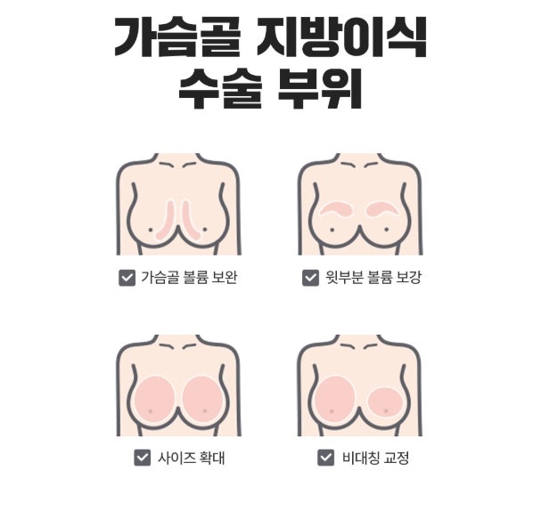 압구정가슴성형 지방이식 후 생착률 높이는 ‘이것’ 사진 6