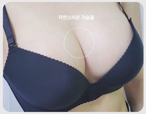 압구정가슴성형 지방이식 후 생착률 높이는 ‘이것’ 사진 7