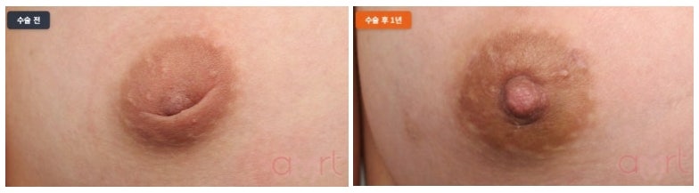 함몰유두수술 비용보다 중요한 기준 1가지 사진 6