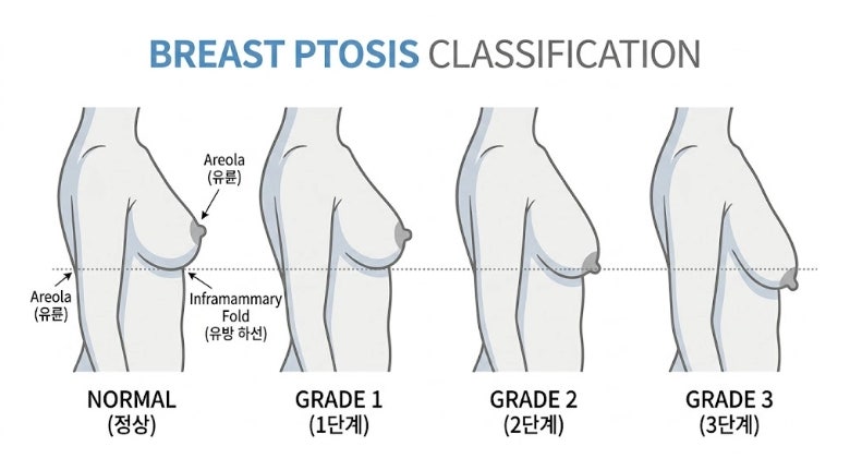 출산 후 가슴 처짐, 성형 수술 고민 중이라면 '이것' 만큼은 아셔야 합니다 사진 2