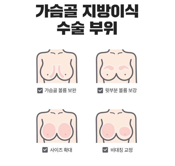 광주가슴수술, 지방이식 VS 보형물 비교? 이 글로 끝냅니다 사진 3