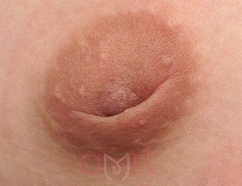 함몰유두수술후기? 10명 중 8명이 '이것' 놓치고 재발하는 이유 사진 5