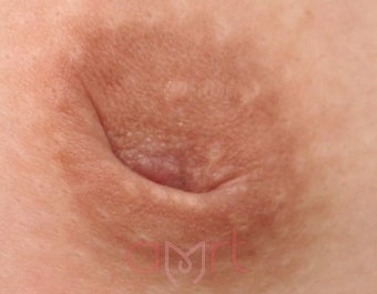 함몰유두수술후기? 10명 중 8명이 '이것' 놓치고 재발하는 이유 사진 4