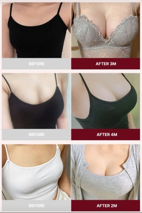 가슴성형잘하는곳? 추천에만 의존하면 놓치는 2가지 사진 2