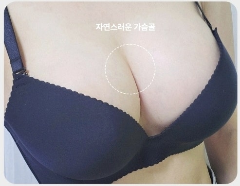 가슴성형외과 추천, 보형물 + 지방이식 같이 하면 좋을까? [20년 경력 전문의 작성] 사진 9