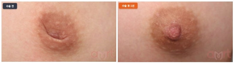 함몰유두 교정기 써도 효과 없어 수술 고민 중이라면 보세요 사진 9