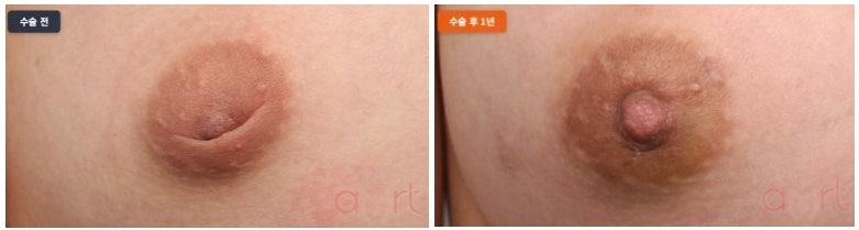 함몰유두 교정기 써도 효과 없어 수술 고민 중이라면 보세요 사진 8