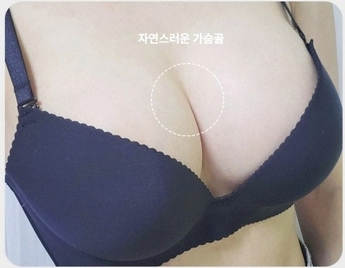 절벽가슴수술? 성형 후 티 나고 어색할까 걱정된다면 사진 8