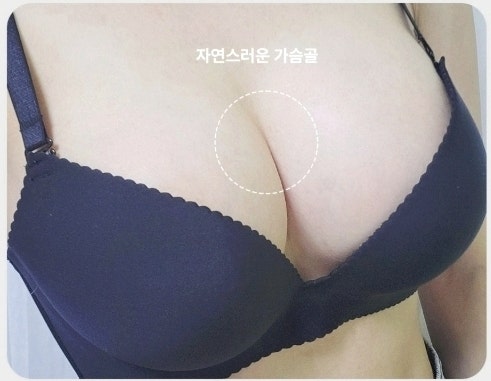 가슴재수술 병원, 가슴골 모양이 마음에 안 들었다면 보세요 사진 10